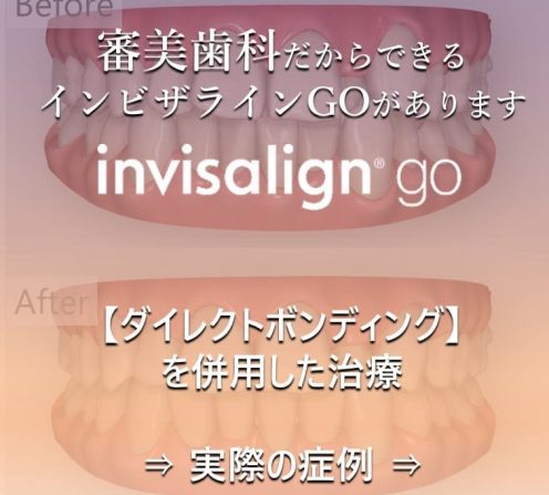 症例紹介「インビザラインGOとダイレクト