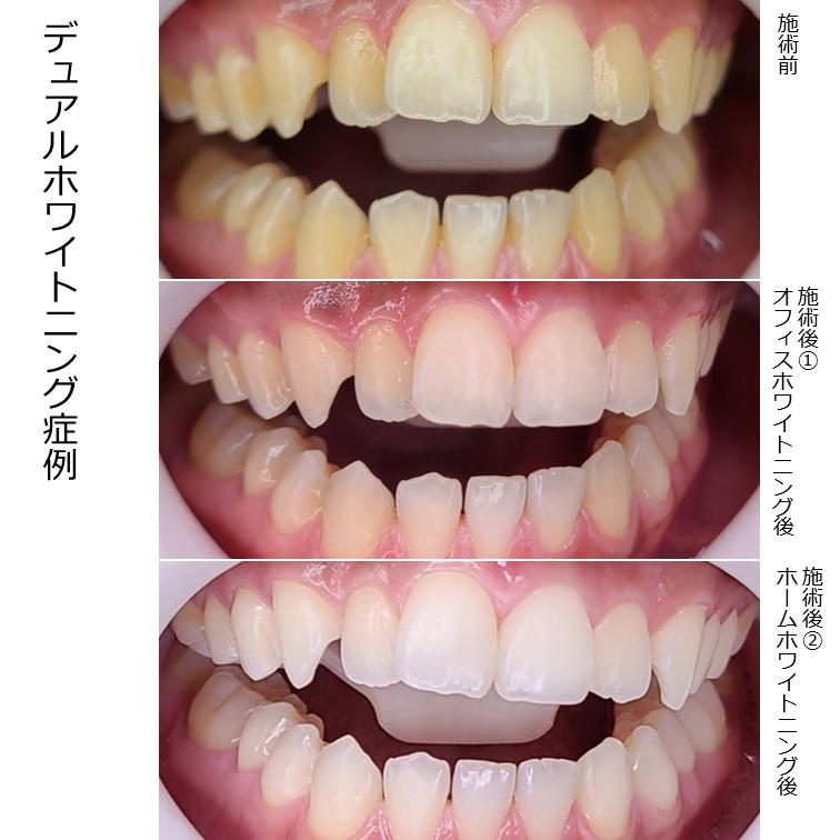 オフィスホワイトニングでの色の上りがとても良かった例です。