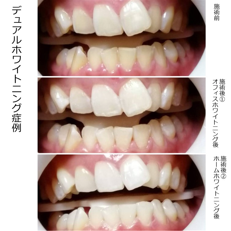 少し歯並びに乱れがある方の例ですが、きれいに白くなりました。