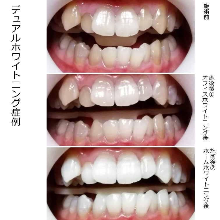 グレー系の色の例です。グレー系は（茶系に比べ）白くなりづらい傾向にありますが、継続することで白くすることができました。
