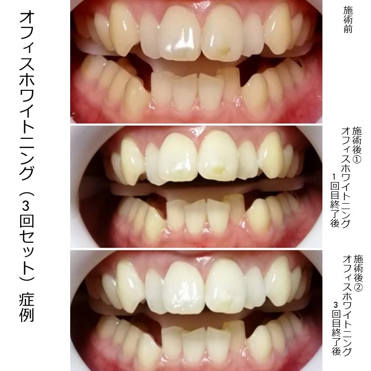 セルフホワイトニングに継続して通っていた方。