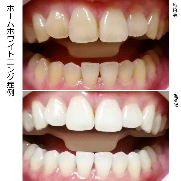 ホームホワイトニングとの相性がとても良かった例。