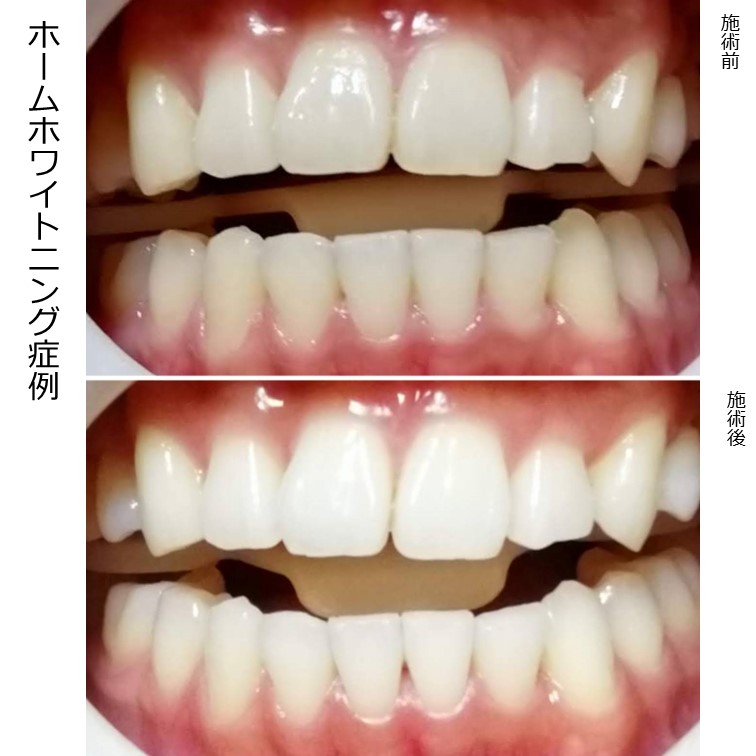 元の色も平均以上の白さの方でしたが、さらに白くなりました。