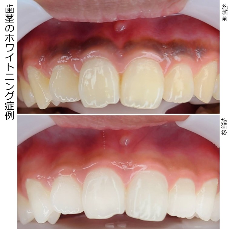 歯茎に沈着していた帯状の色素でしたが、1回の施術でとてもきれいに取れました。