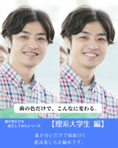 札幌デンタルケアの医療ホワイトニング