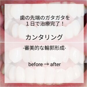 札幌デンタルケア　審美歯科　カンタリング症例