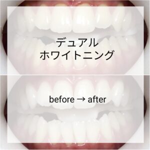 症例　デュアルホワイトニング　札幌デンタルケア