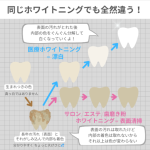 歯科医療ホワイトニングとセルフホワイトニングサロンの違い