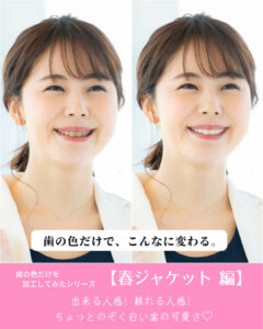 札幌デンタルケア 歯の色だけ変えてみたシリーズ