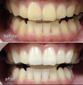 札幌デンタルケアのデュアルホワイトニング　実際の症例写真