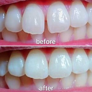 札幌デンタルケア　すきっ歯のダイレクトボンディング症例「審美歯科」